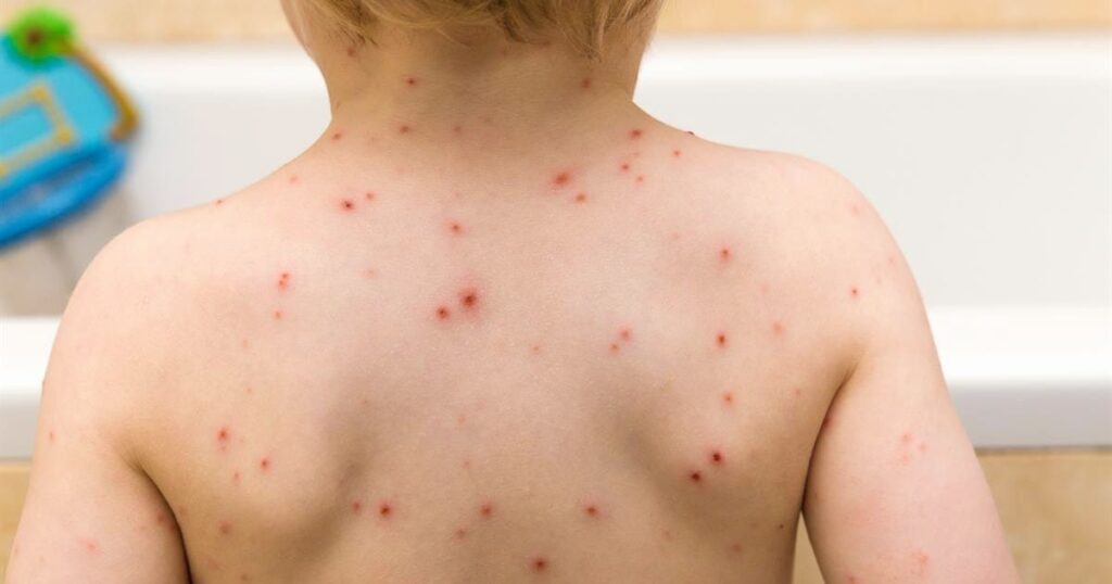 طرق تخفيف حكة جدري الماء